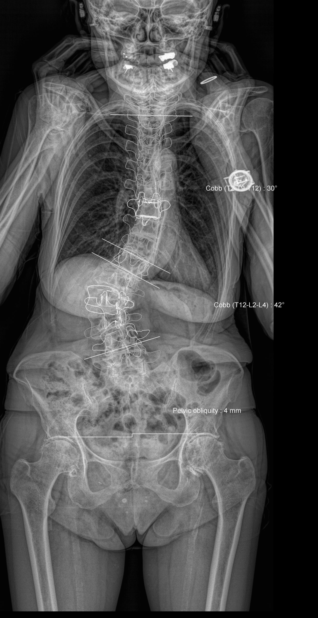 Spine 2D Frontal with 3D parameters