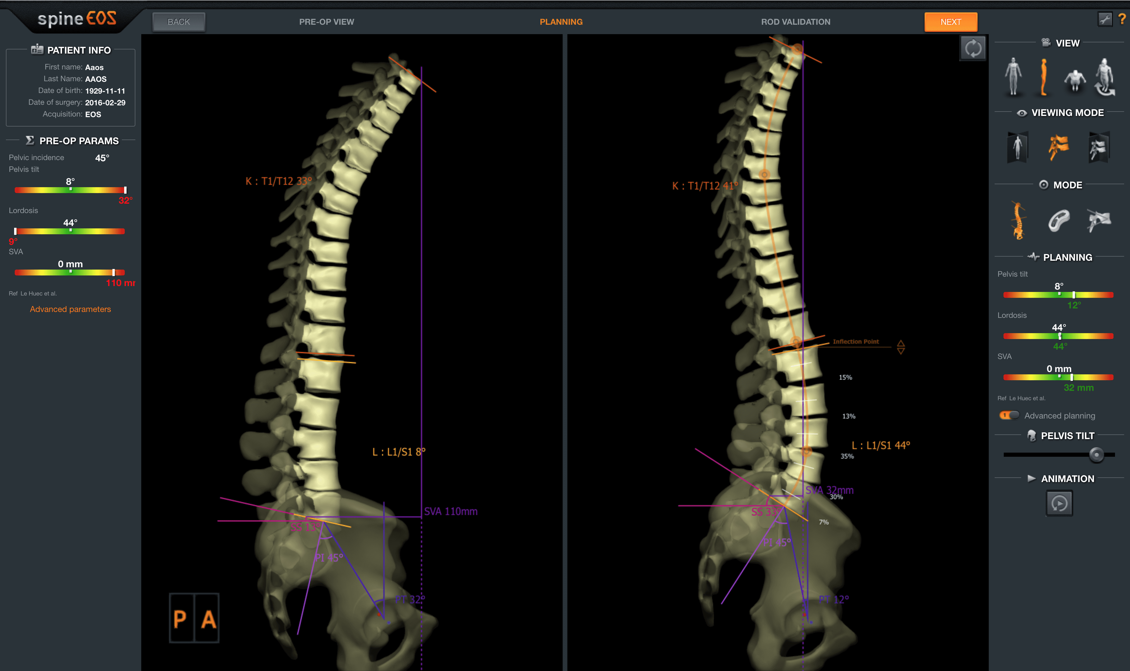 spineEOS Degenerative Interface